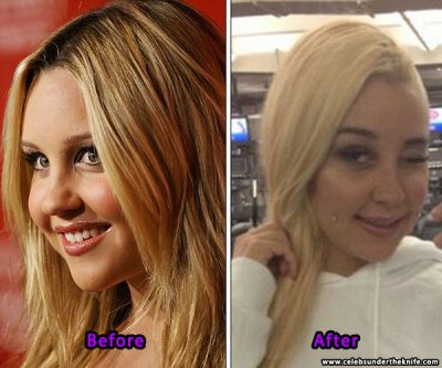 Amanda Bynes Plastic Surgey Photos Before And After