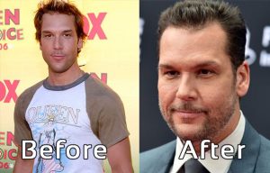 Dane Cook Plastic Surgery Photos Before After