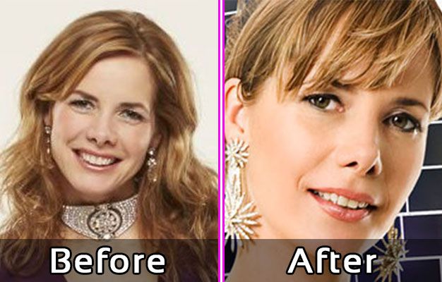 Darcey Bussel Plastic Surgery Photos Nose Job