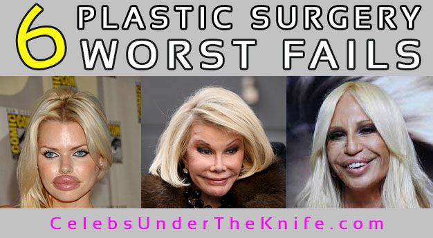 6 Worst Plastic Surgery Fails – Before and After Photos