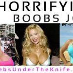 9 Breast Implants Disasters Gone Wrong