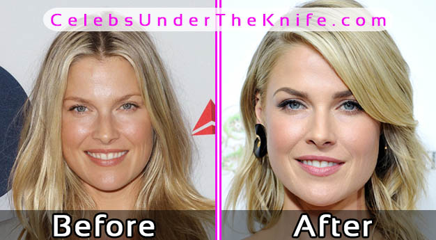 Ali Larter Plastic Surgery Before and After