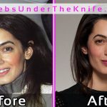 Amal Alamuddin Plastic Surgery Pics Before After