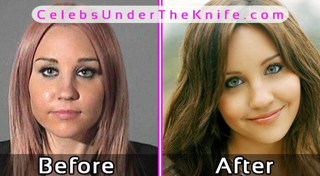 Amanda Bynes Plastic Surgery Before After Photos
