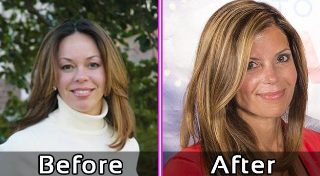 Amy Yancey Plastic Surgery Face Lift