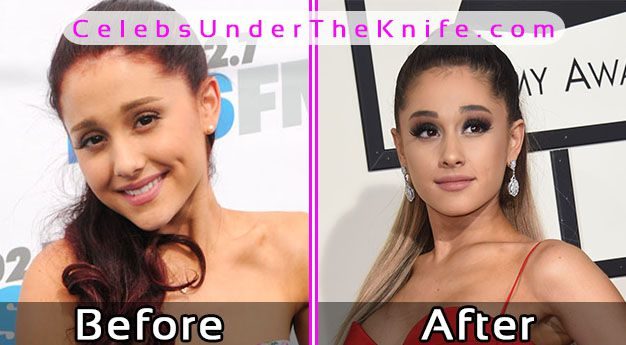 Ariana Grande Plastic Surgery Pics Before After 