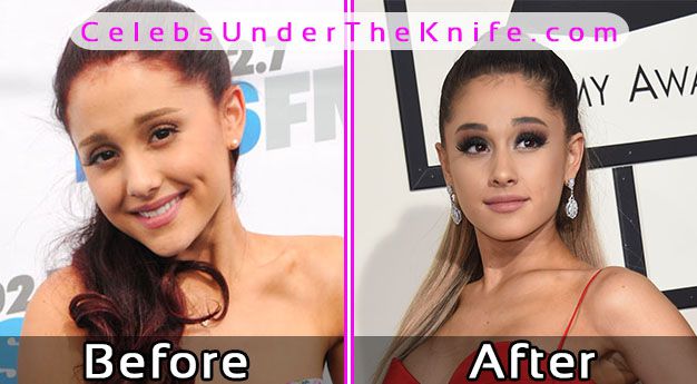 Ariana Grande Plastic Surgery Pics Before After