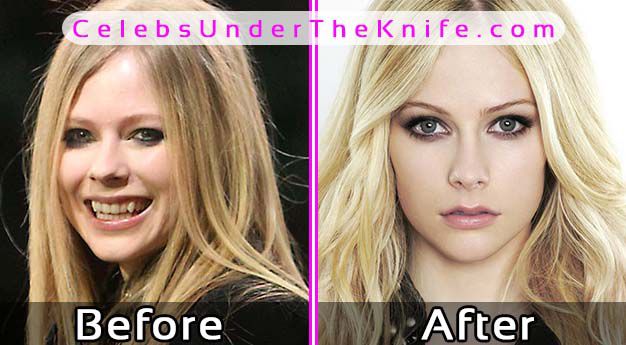 Avril Lavigne Before and After Plastic Surery