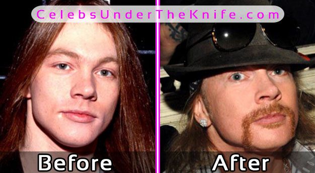 Axl Rose Plastic Surgery Photos Before After