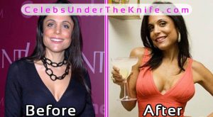 Bethenny Frankel Breast Implants Gone Wrong Before and After