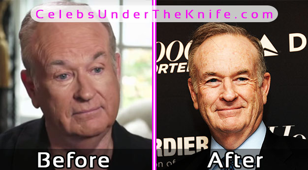 Has Bill O’ Reilly Gone Under the Knife?