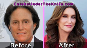 Bruce-Caitlyn Jenner Plastic Surgery Photos