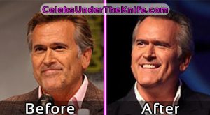 Bruce Campbell Under The Knife - Plastic Surgery