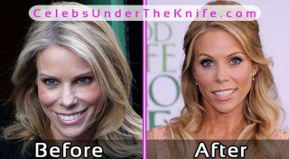 Cheryl Hines Plastic Surgery Before After