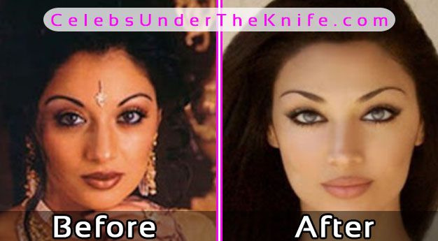 Claudia Lynx Plastic Surgery Photos Before After