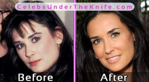 Demi Moore Plastic Surgery Before After