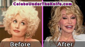 Dolly Parton - Plastic Surgery Disaster Before After