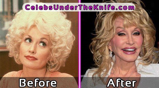 Dolly Parton - Plastic Surgery Disaster Before After