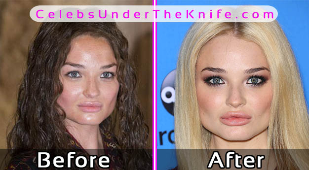 Emma Rigby Before and After Plastic Surgery Photos