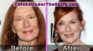 Frances Conroy Plastic Surgery Before After