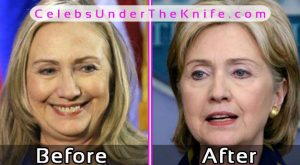 Hilary Clinton Plastic Surgery Before After