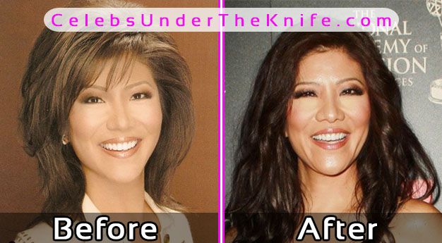 Julie Chen Plastic Surgery Photos Before After