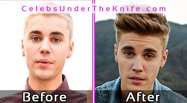 Justin Bieber Plastic Surgery Photos Before After