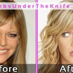 Kaitlin Olson Before After Plastic Surgery Pics