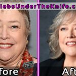 Kathy Bates Plastic Surgery Before and After