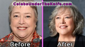 Kathy Bates Plastic Surgery Before and After