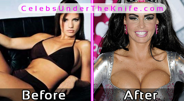 Katie Price Breast Implants Gone Wrong - Before and After