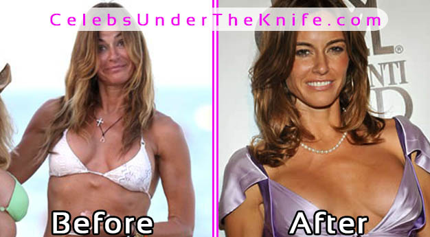 Kelly Bensimon Bad Boob Job Fail - Pics