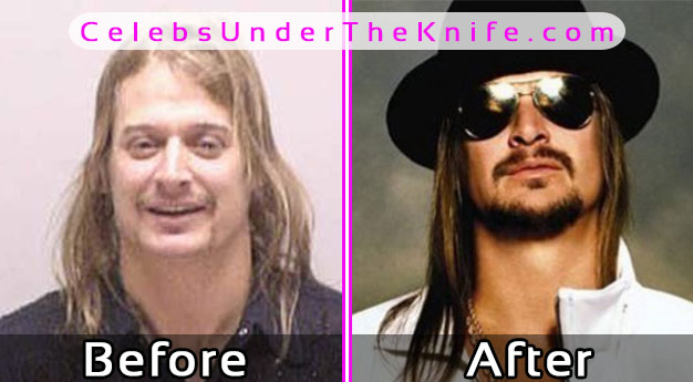 Kid Rock Plastic Surgery Before and After Photos