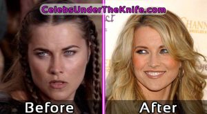 Lucy Lawless Plastic Surgery Photos