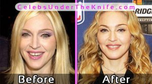 Madonna Plastic Surgery Photos Before After