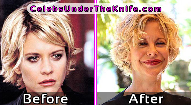 Meg Ryan - Plastic Surgery Disaster Photos