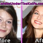 Melissa Benoist Before After Plastic Surgery