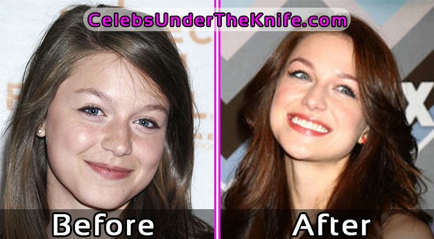 Melissa Benoist Pics Before and After Plastic Surgery