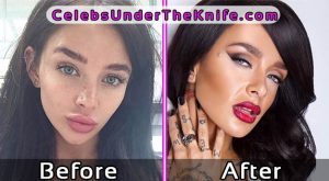 Mercedes Edison Pics Plastic Surgery Before and After