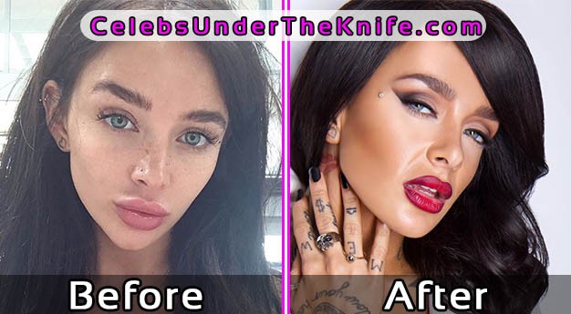 Mercedes Edison Pics – Before After Plastic Surgery