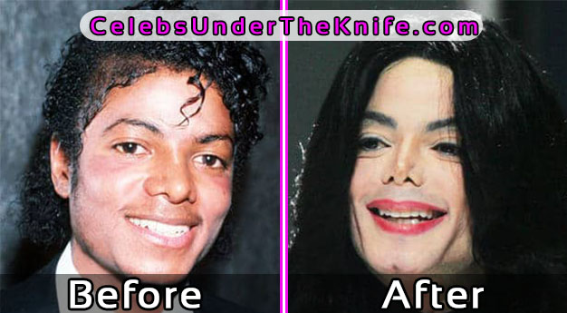 Michael Jackson - Worst Plastic Surgery Celebrity Before After