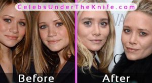 Olsen Twins Plastic Surgery Before After