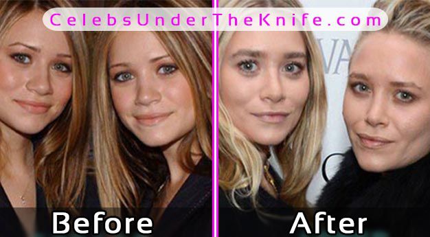 Olsen Twins Plastic Surgery Photos Before After
