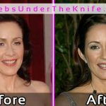 Patricia Heaton Plastic Surgery Pics Before After