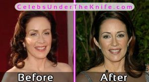 Patricia Heaton Plastic Surgery Pics Before After