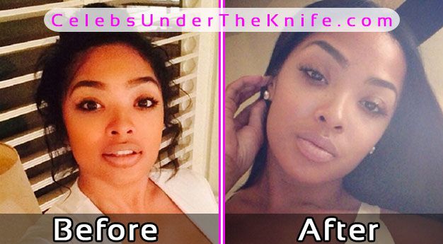 Princess Love Plastic Surgery Photos Before After
