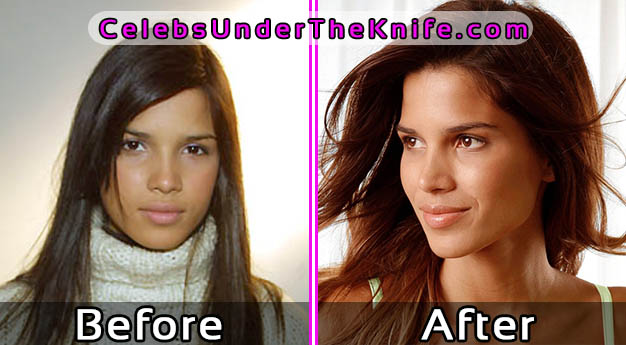 Raica Oliveira Plastic Surgery – Before and After Photos