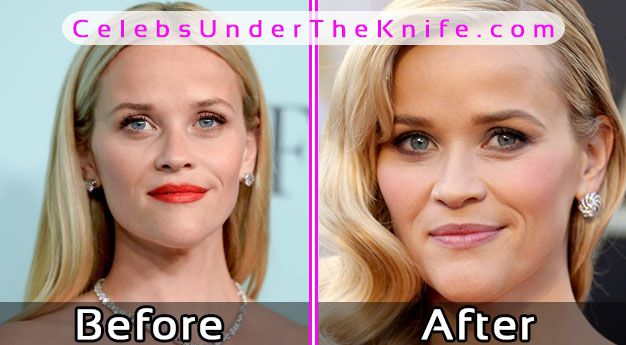 Reese Witherspoon Plastic Surgery Before After Pics