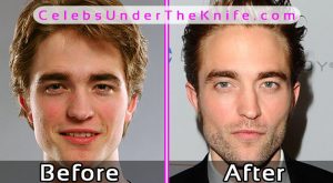 Robert Pattinson Before After Photos Plastic Surgery