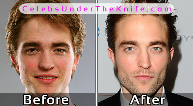 Robert Pattinson Plastic Surgery Photos – Before and After